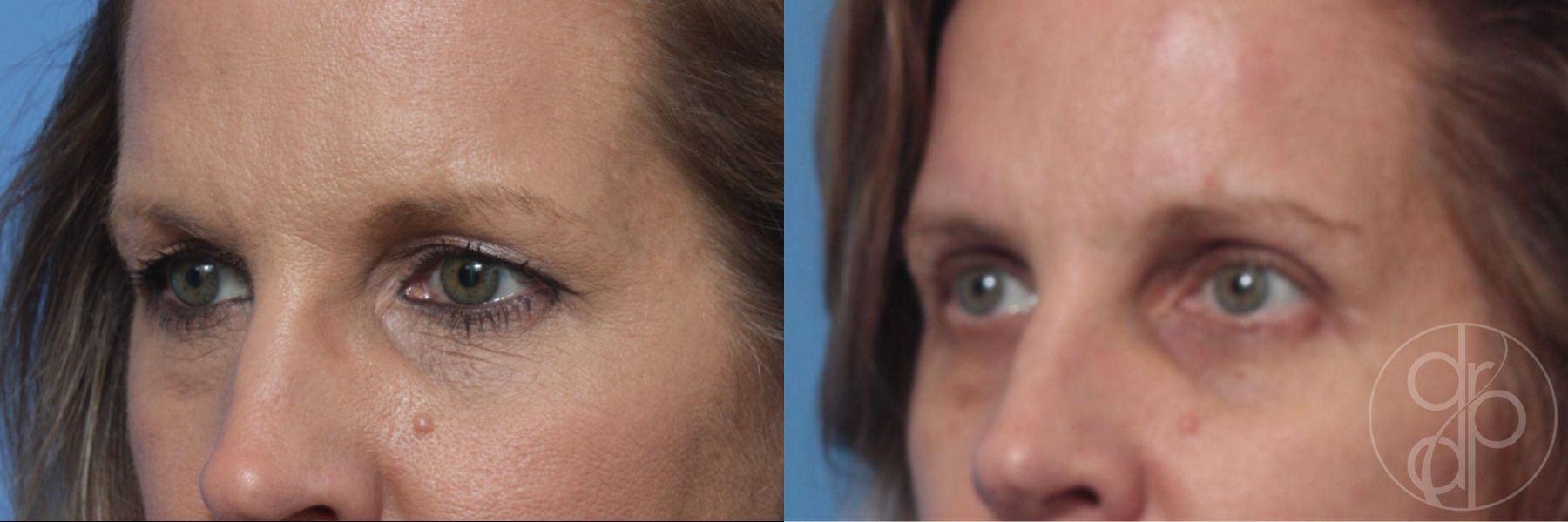 Before and after Blepharoplasty case 29745 - Angle 2