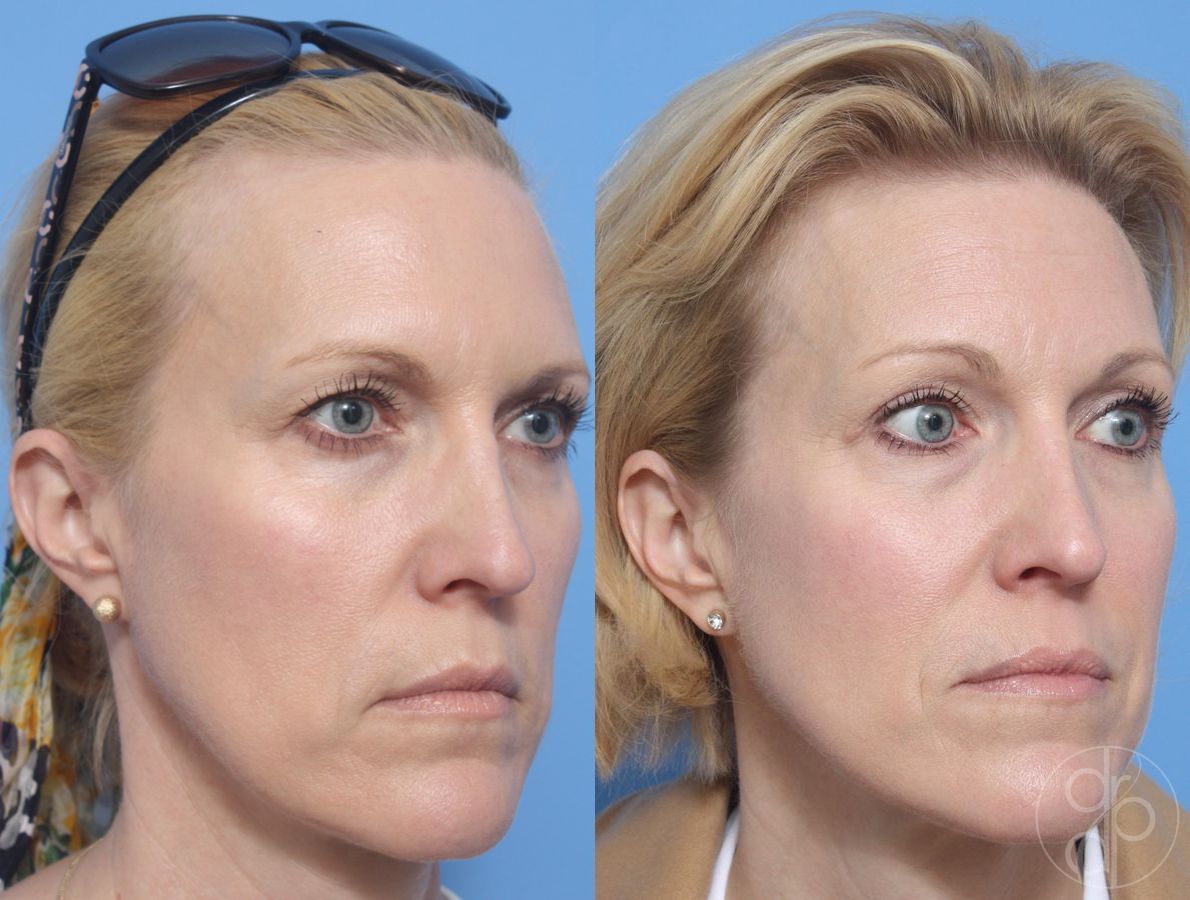 Before and after Blepharoplasty case 29754 - Angle 2