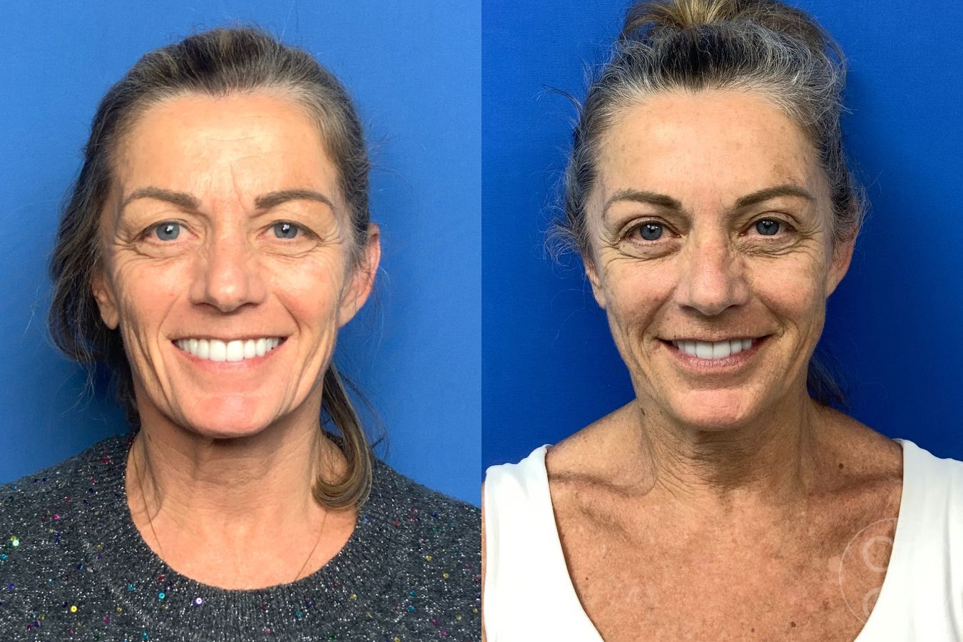 Before and after Blepharoplasty case 46270 - Angle 2