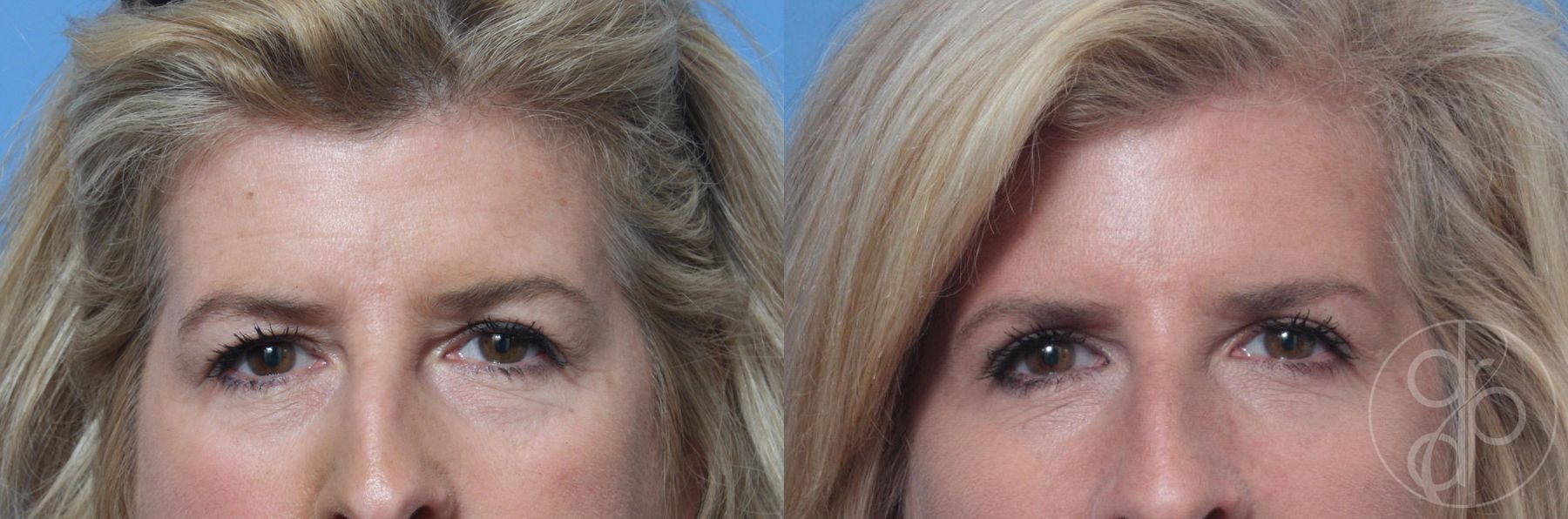 Before and after Blepharoplasty case 29750
