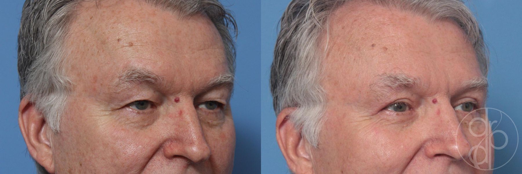 Before and after Blepharoplasty case 29744 - Angle 2