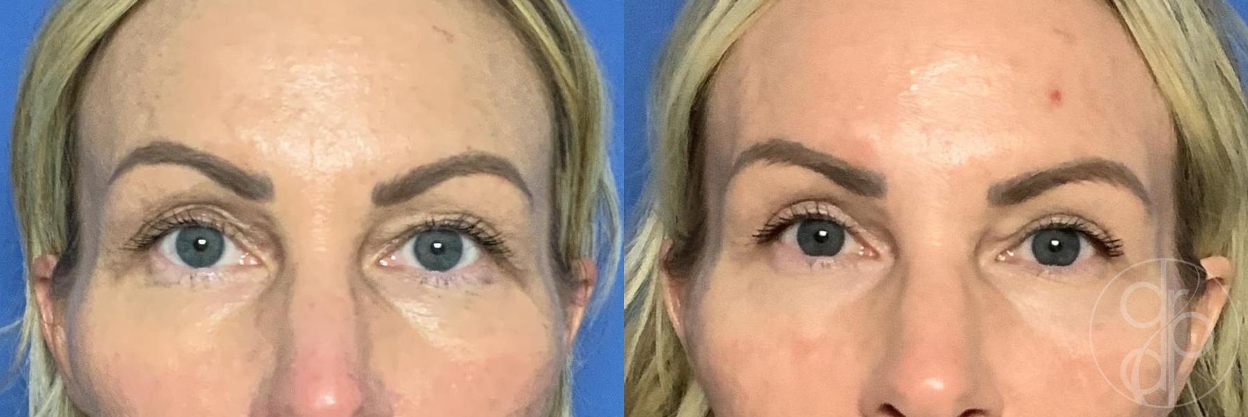 Before and after Blepharoplasty case 30004