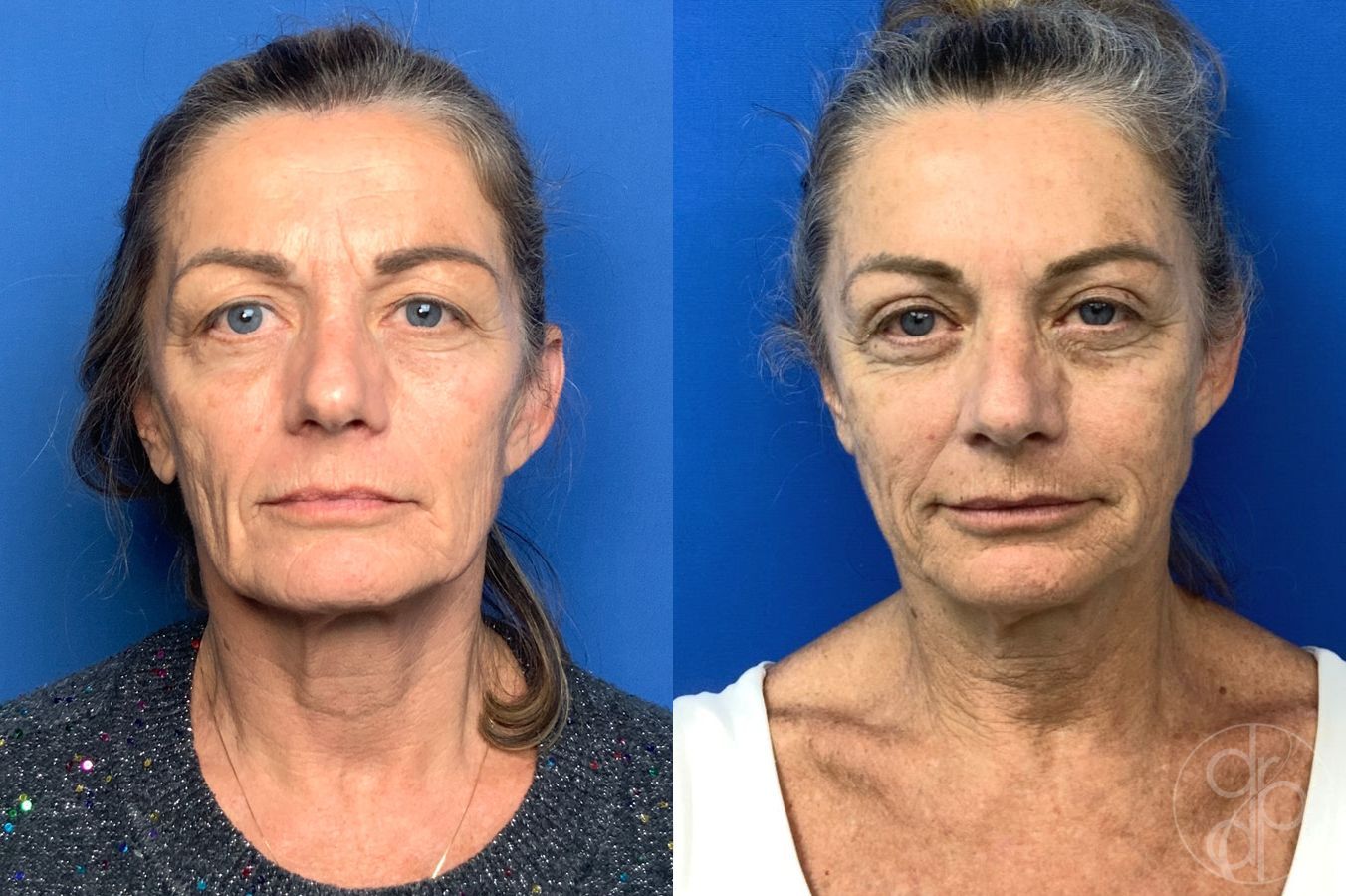 Before and after Blepharoplasty case 46270