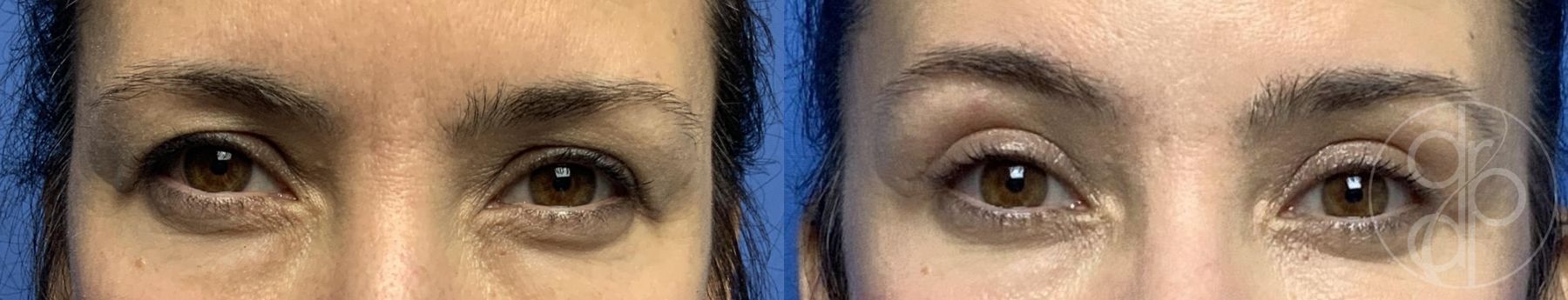 Before and after Blepharoplasty case 29807 - Angle 2