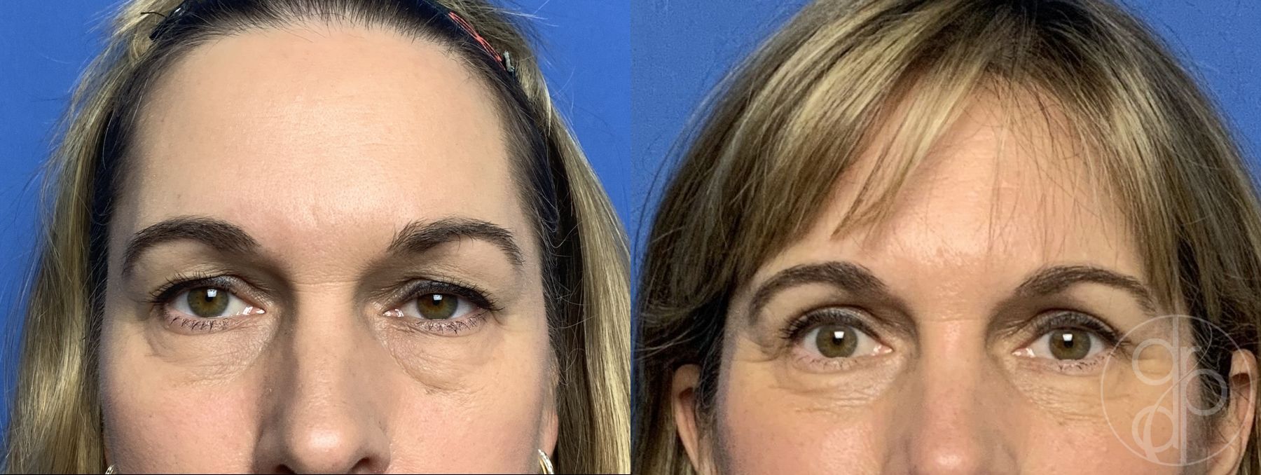 Before and after Blepharoplasty case 29886