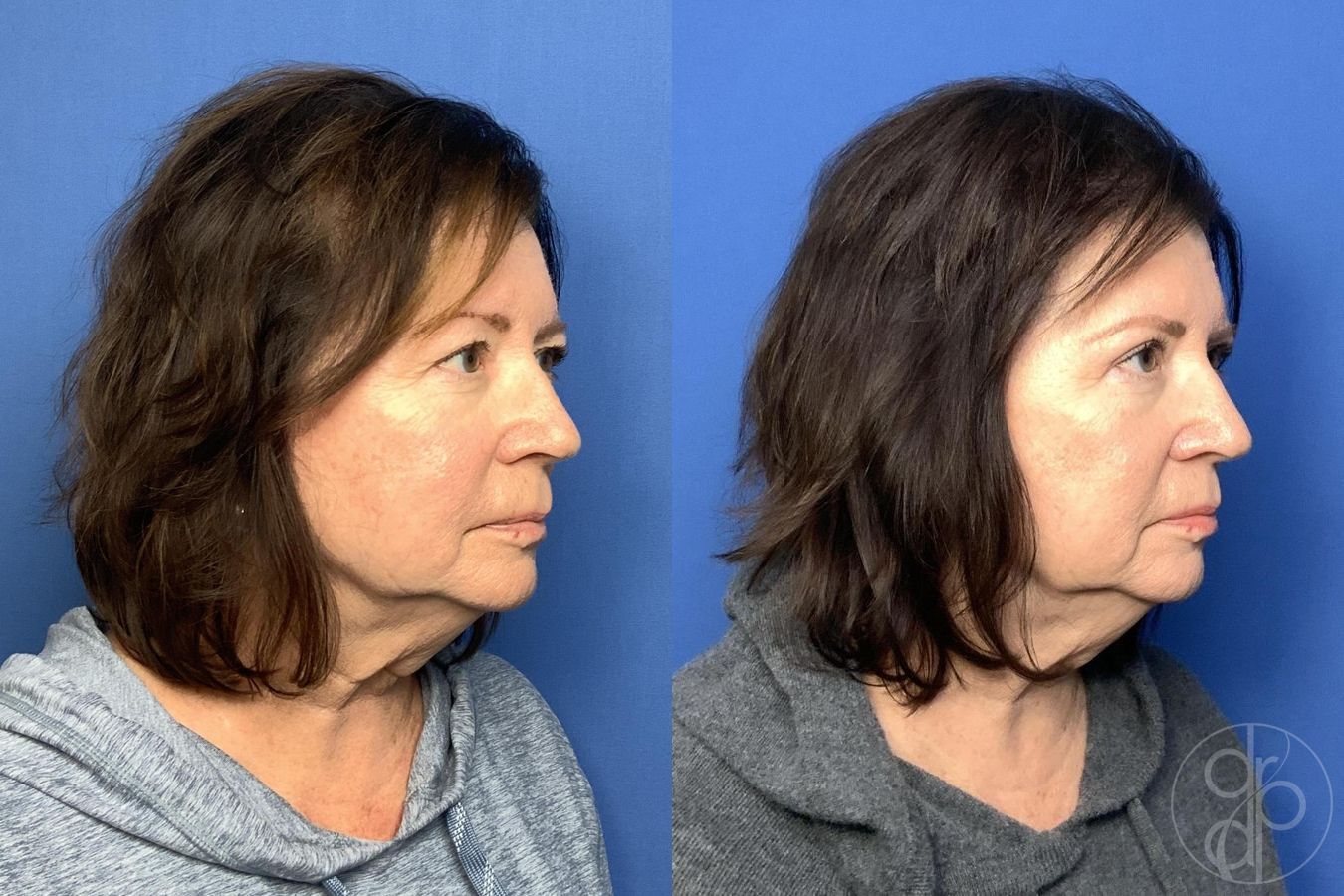 Before and after Blepharoplasty case 30002 - Angle 2