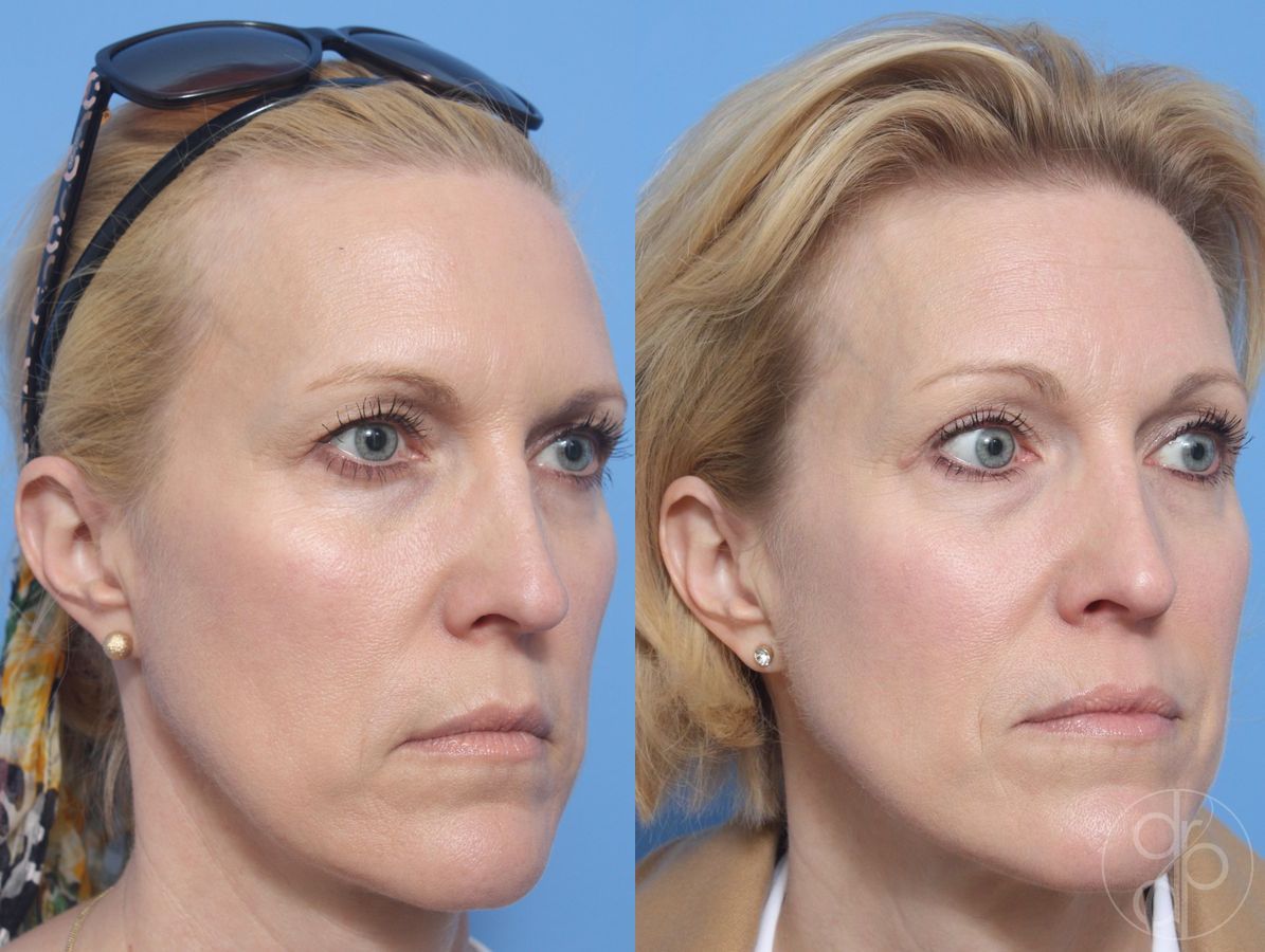Before and after Blepharoplasty case 29754 - Angle 2