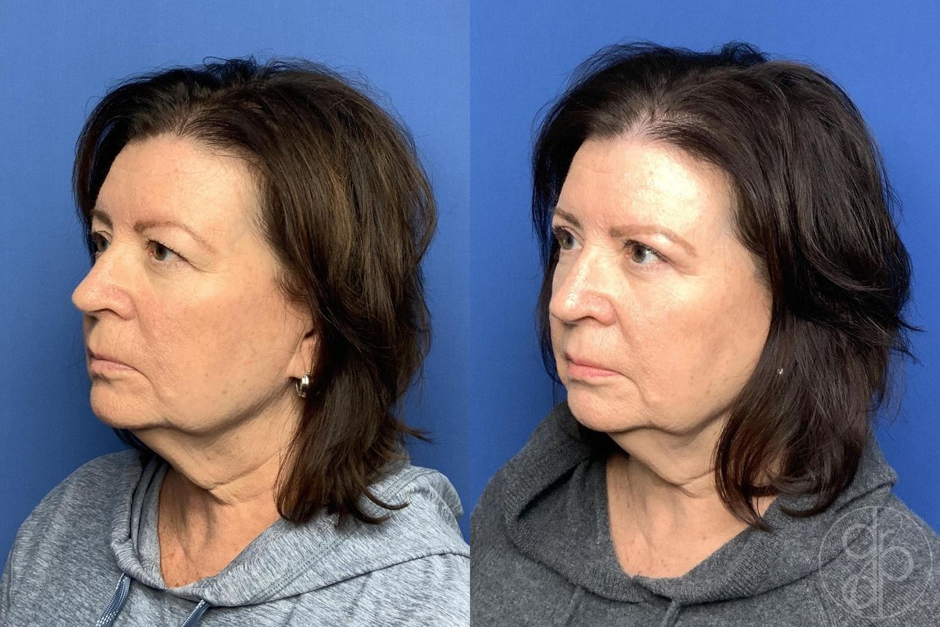 Before and after Blepharoplasty case 30002 - Angle 3