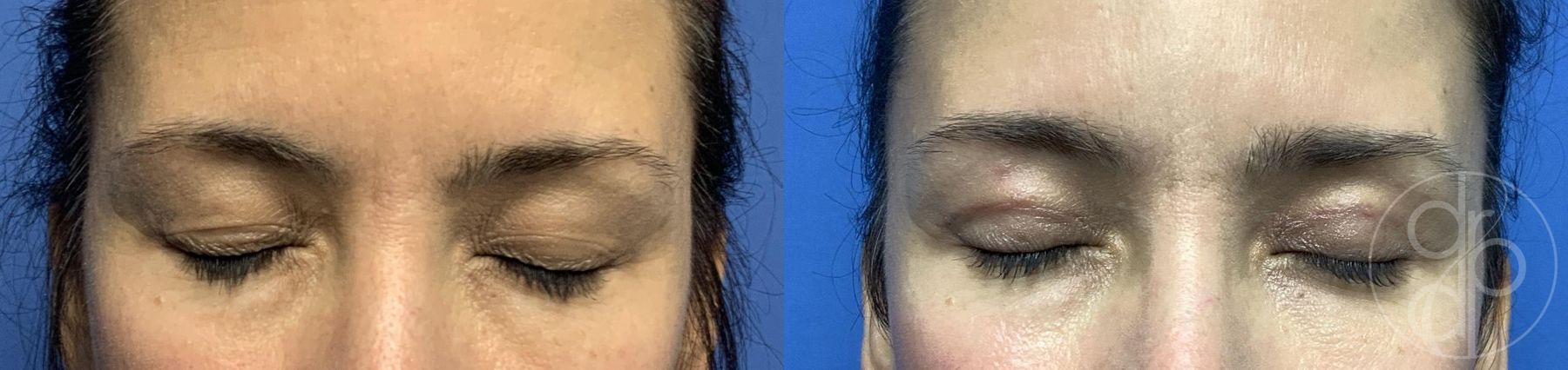 Before and after Blepharoplasty case 29807