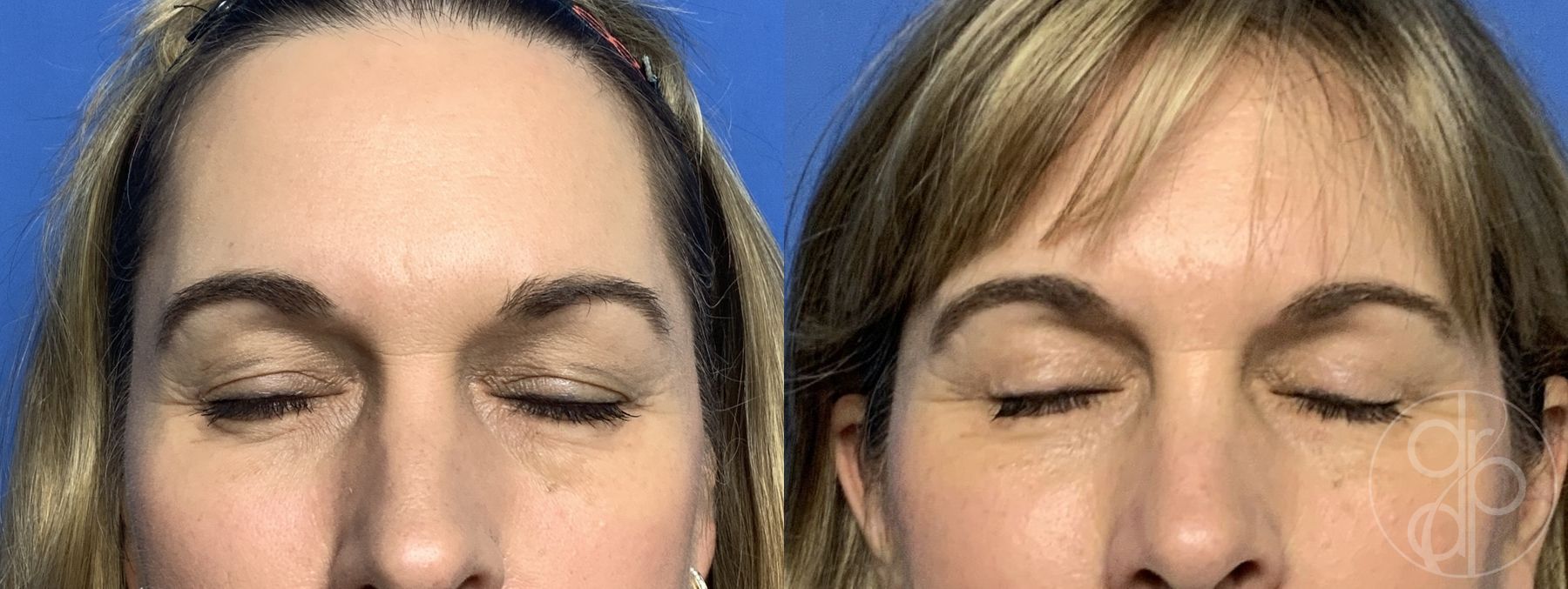 Before and after Blepharoplasty case 29886 - Angle 2