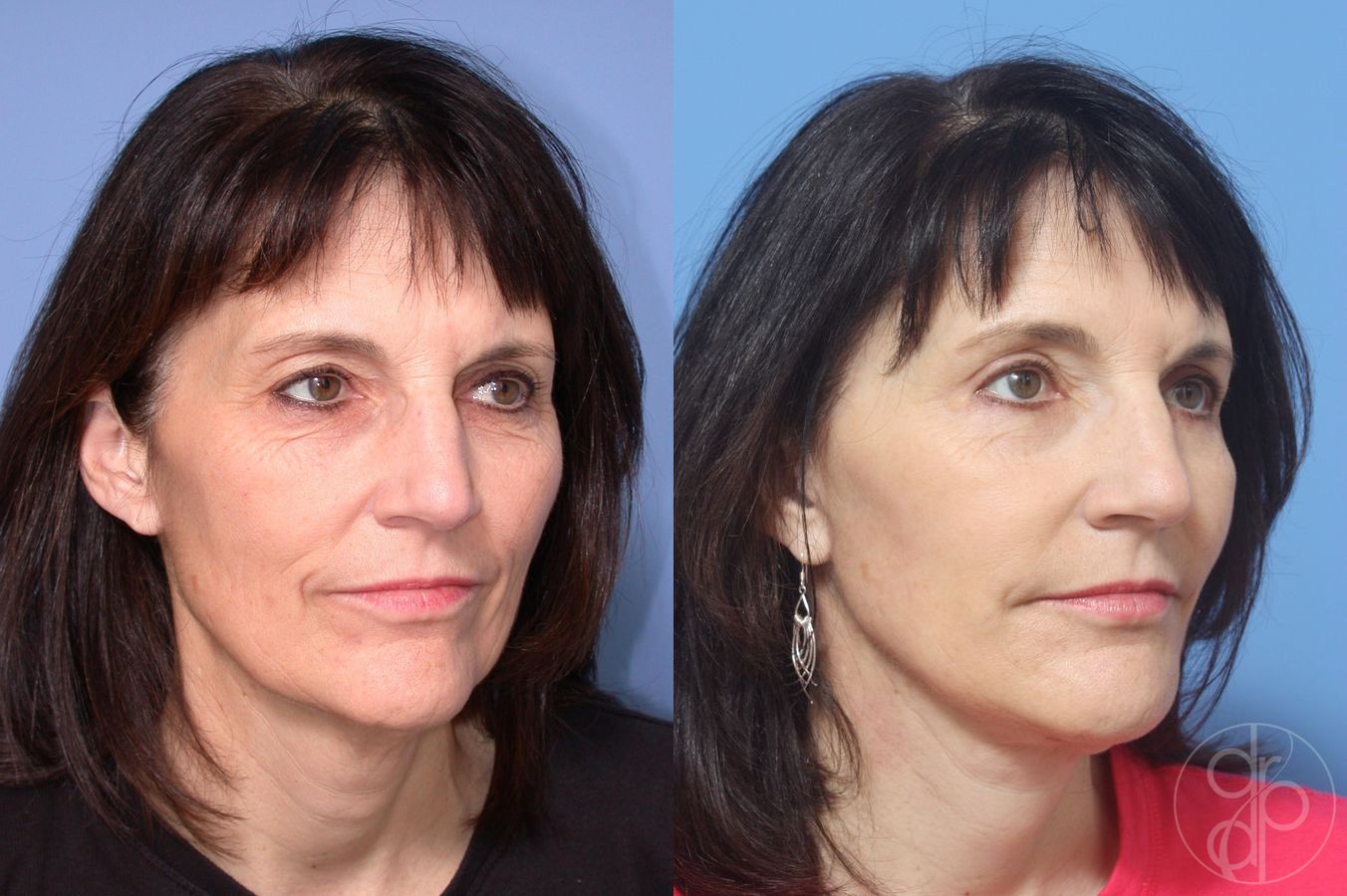 Before and after Blepharoplasty case 29746 - Angle 2