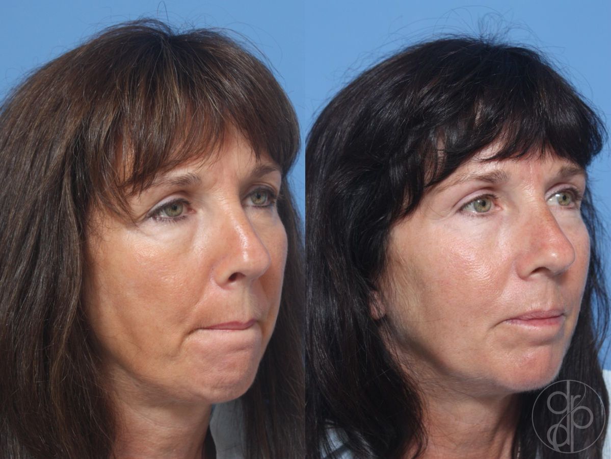 Before and after Blepharoplasty case 29749 - Angle 2