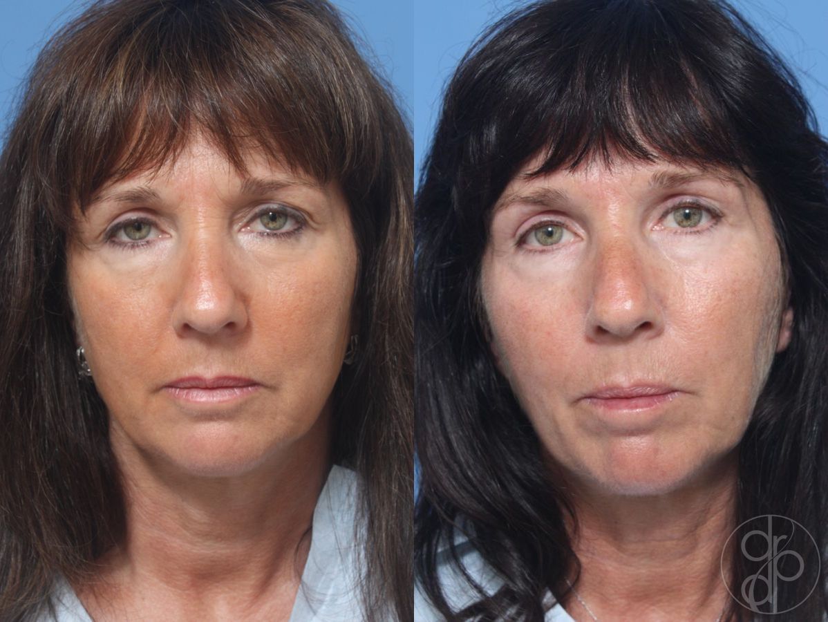Before and after Blepharoplasty case 29749