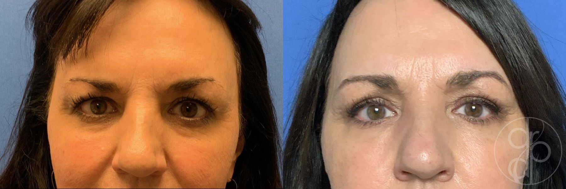 Before and after Blepharoplasty case 29743