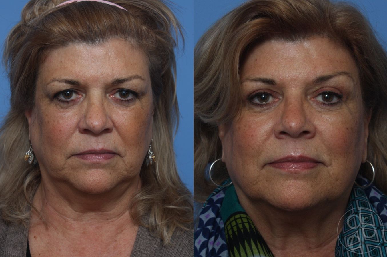 Before and after Blepharoplasty case 29825