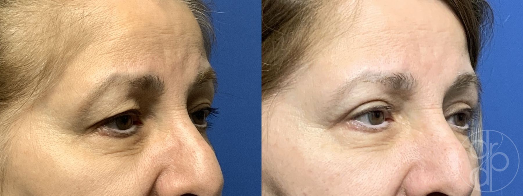 Before and after Blepharoplasty case 29884 - Angle 2