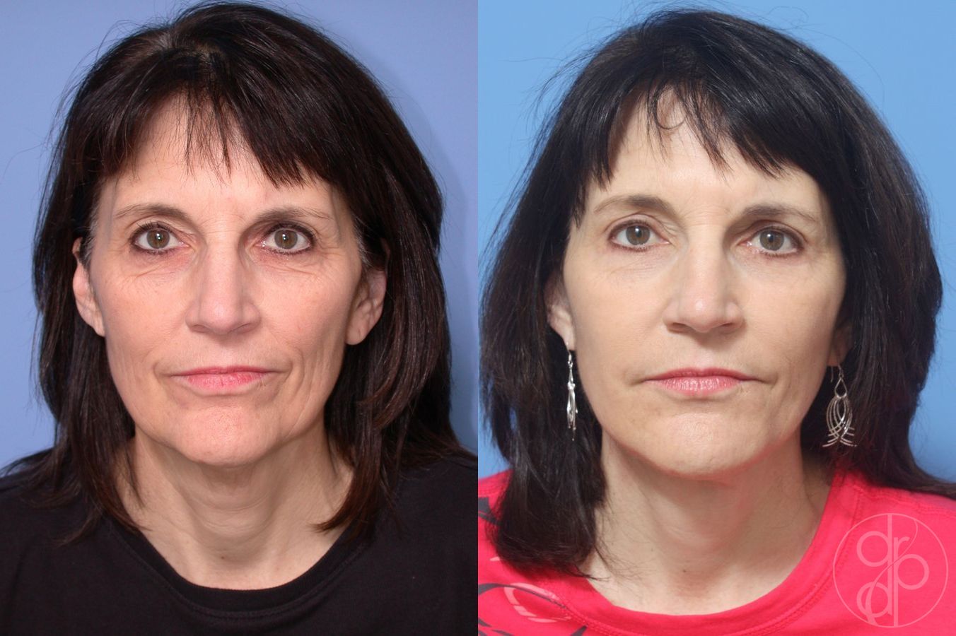 Before and after Blepharoplasty case 29746