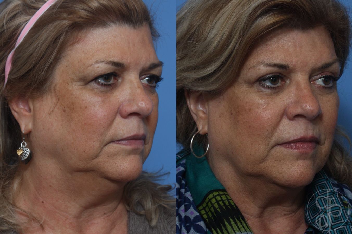 Before and after Blepharoplasty case 29825 - Angle 2