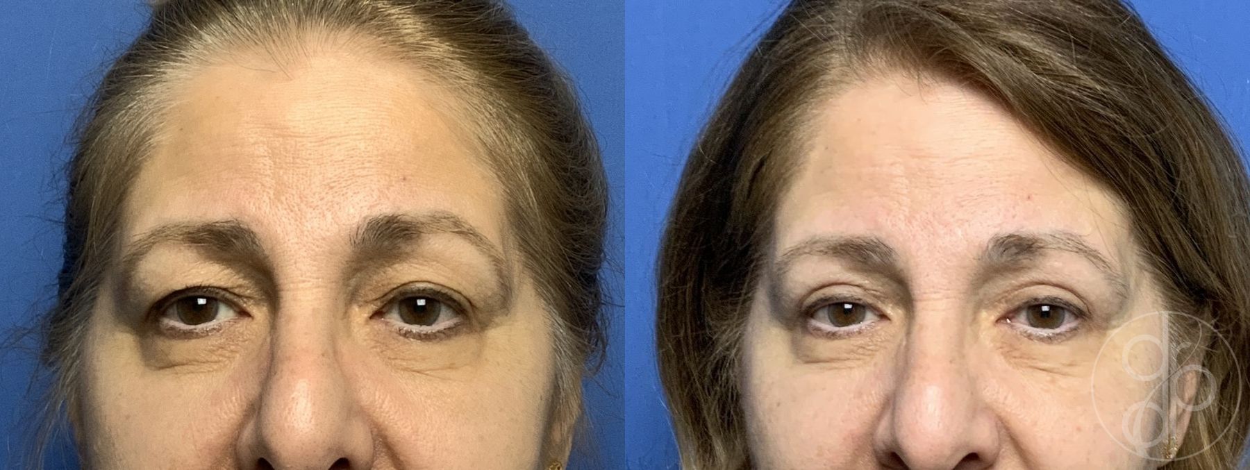 Before and after Blepharoplasty case 29884