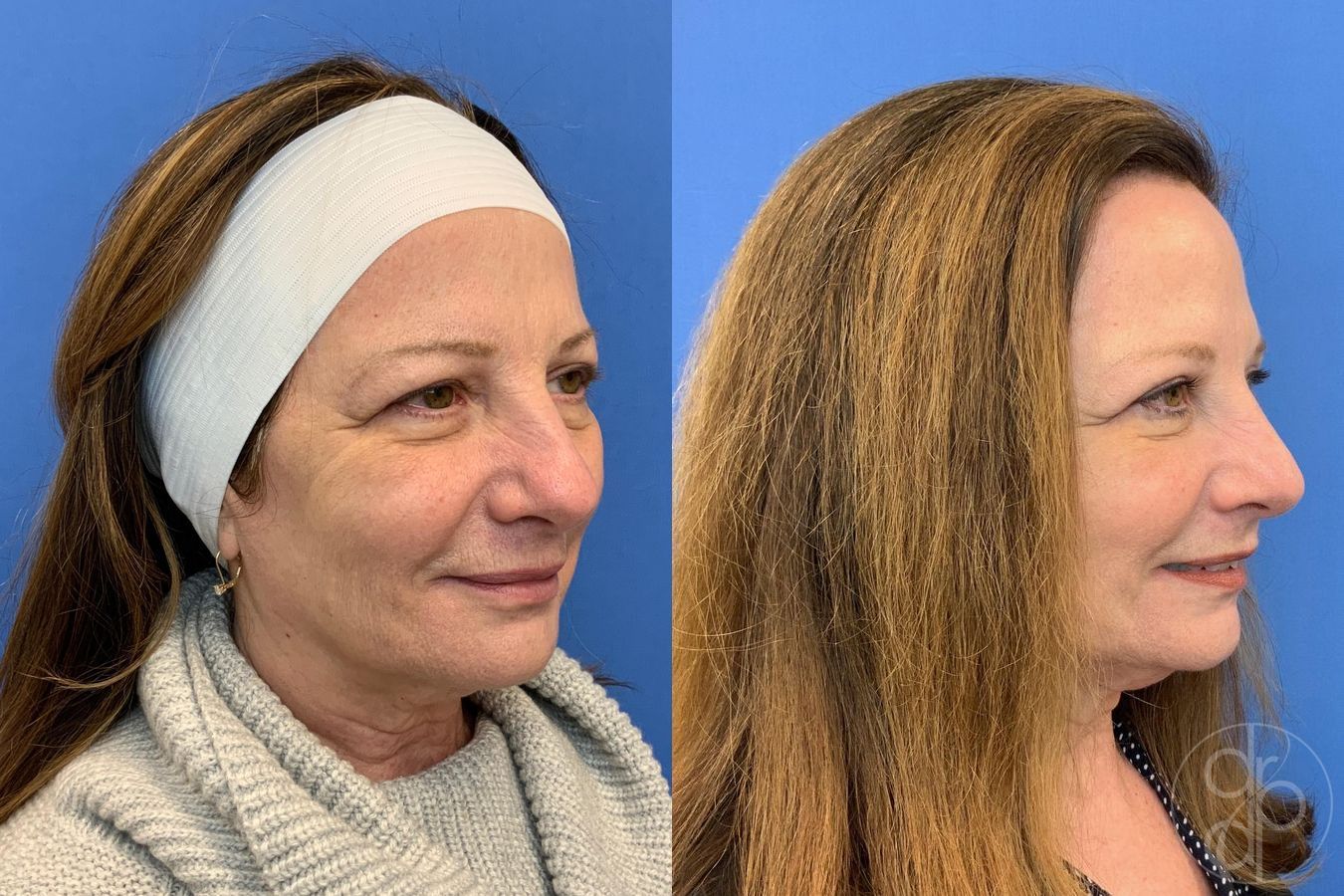 Before and after Blepharoplasty case 29752 - Angle 2