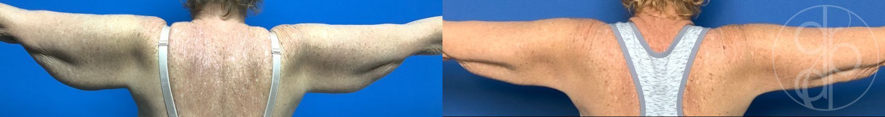 Before and after Brachioplasty case 43756