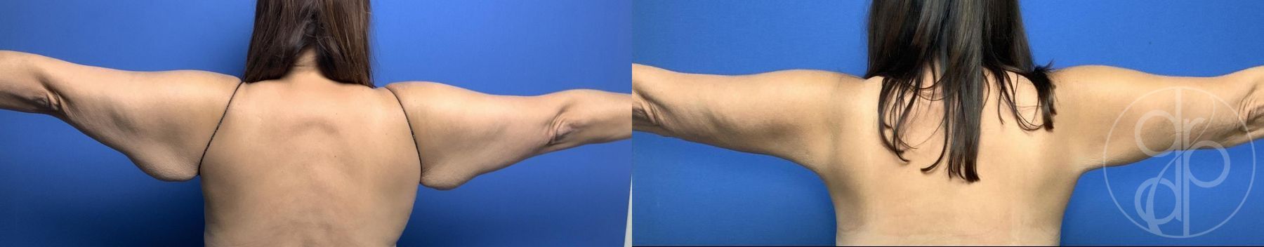 Before and after Brachioplasty case 29965