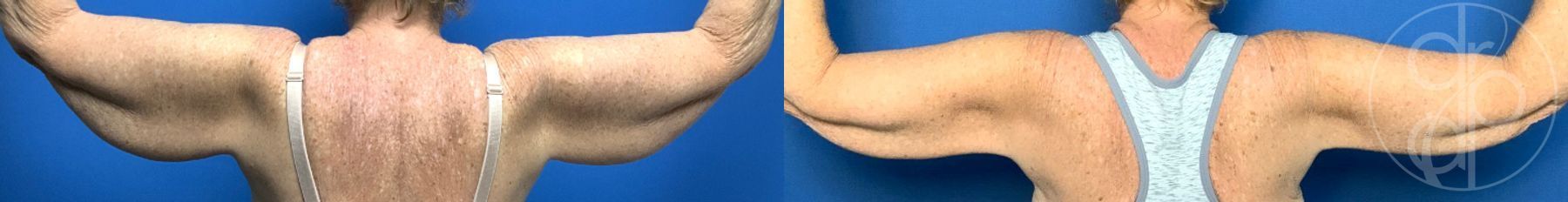 Before and after Brachioplasty case 43756 - Angle 2