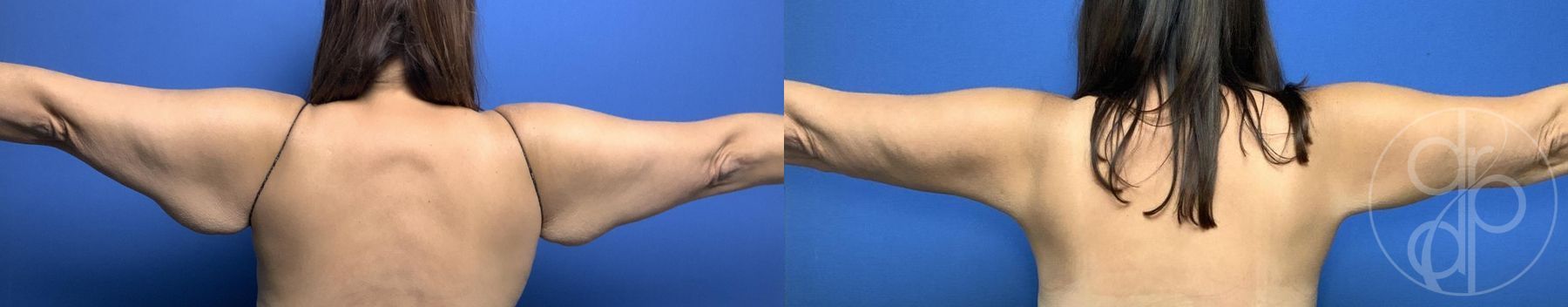 Before and after Brachioplasty case 29965