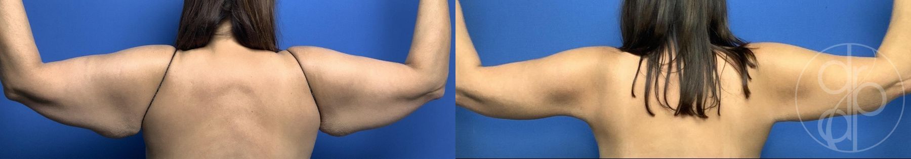 Before and after Brachioplasty case 29965 - Angle 2