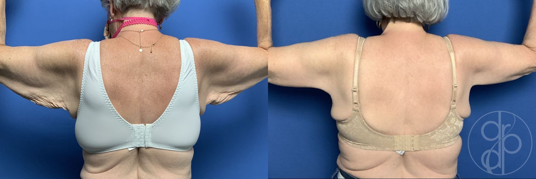 Before and after Brachioplasty case 29741