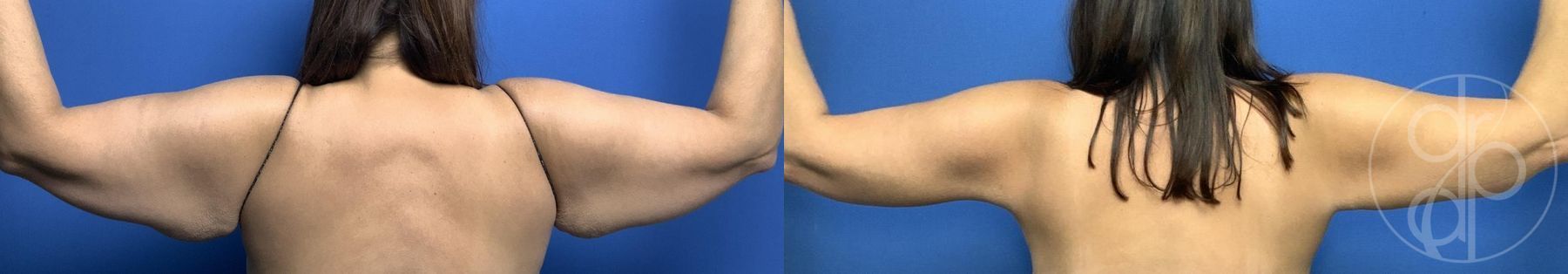 Before and after Brachioplasty case 29965 - Angle 2
