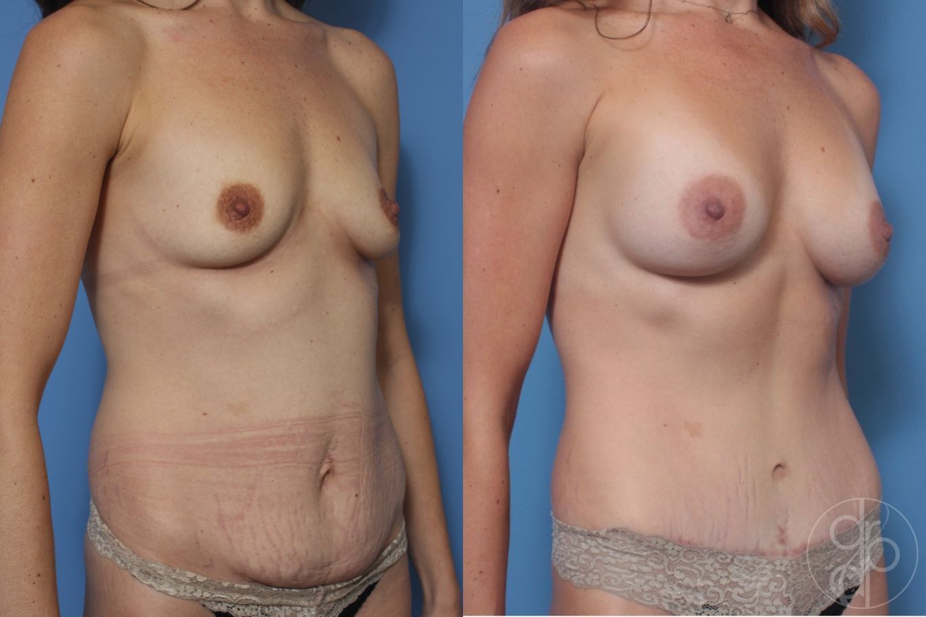 Before and after Mommy Makeover case 29733 - Angle 2