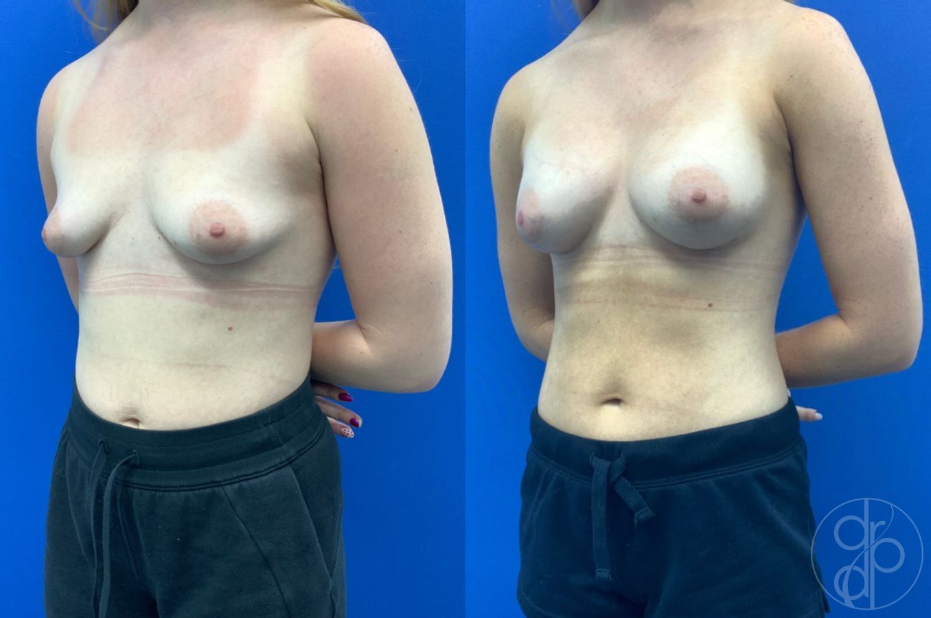Before and after Tubular Breast Surgery case 46765 - Angle 3