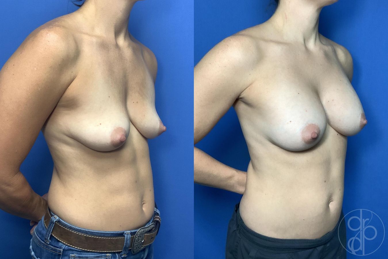 Before and after Breast Augmentation case 29988 - Angle 2