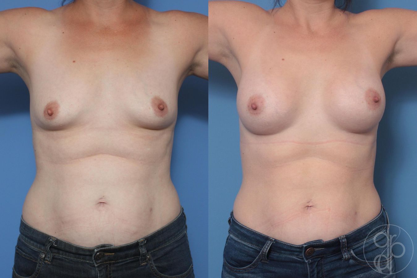 Before and after Breast Augmentation case 29998 - Angle 2