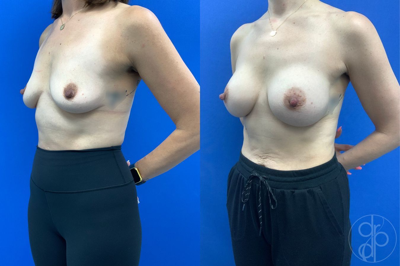 Before and after Breast Augmentation case 46262 - Angle 3