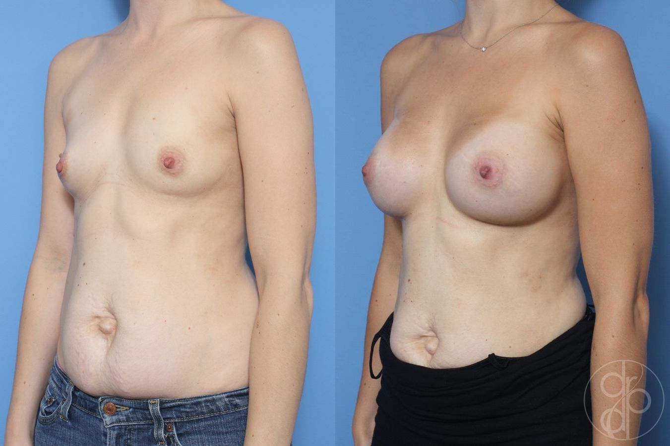 Before and after Breast Augmentation case 29961 - Angle 3