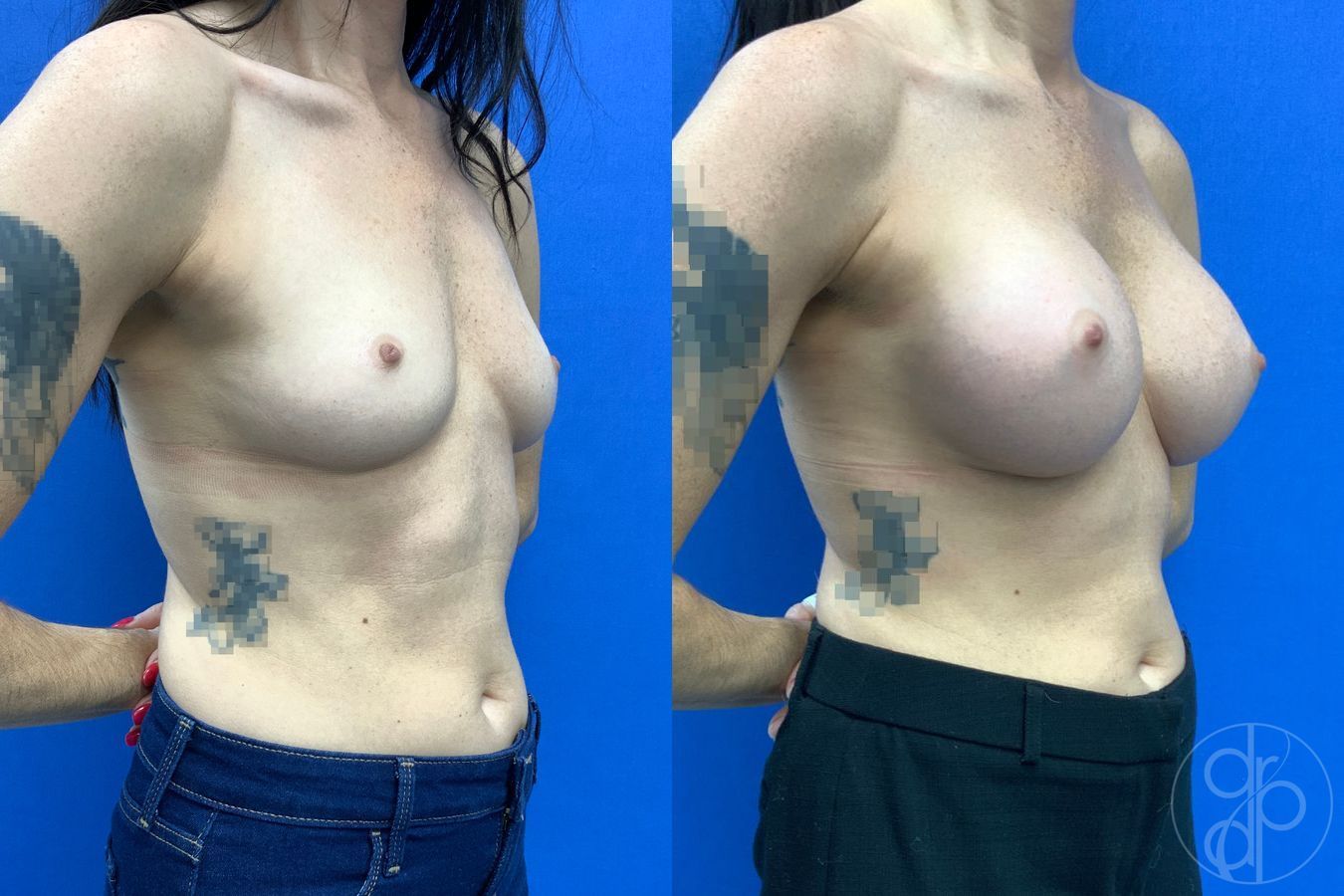 Before and after Breast Augmentation case 43194 - Angle 3