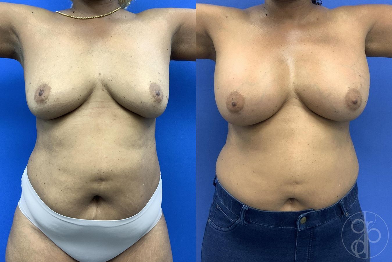 Breast Augmentation - Thumbnail 2