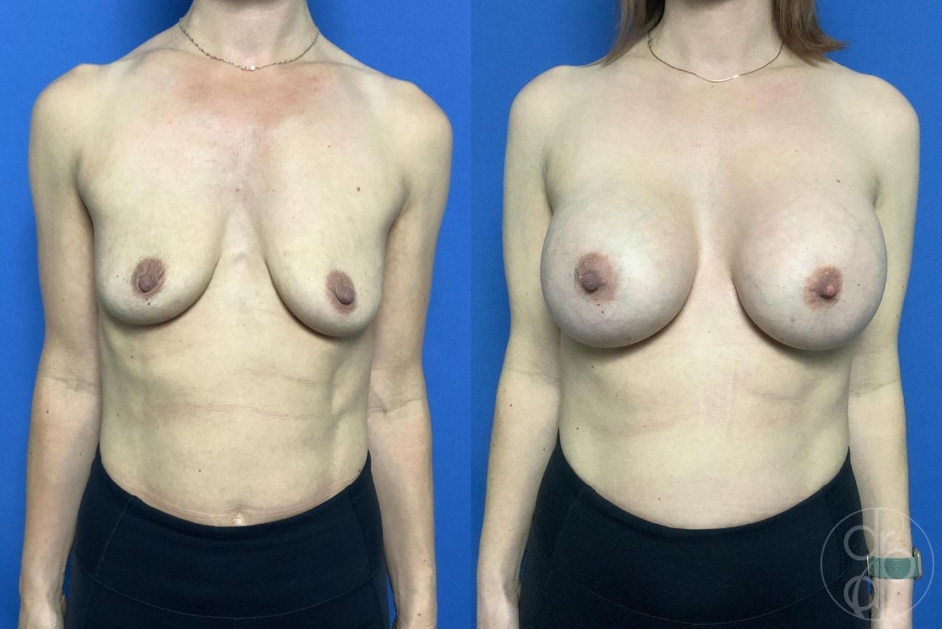 Before and after Breast Augmentation case 29999