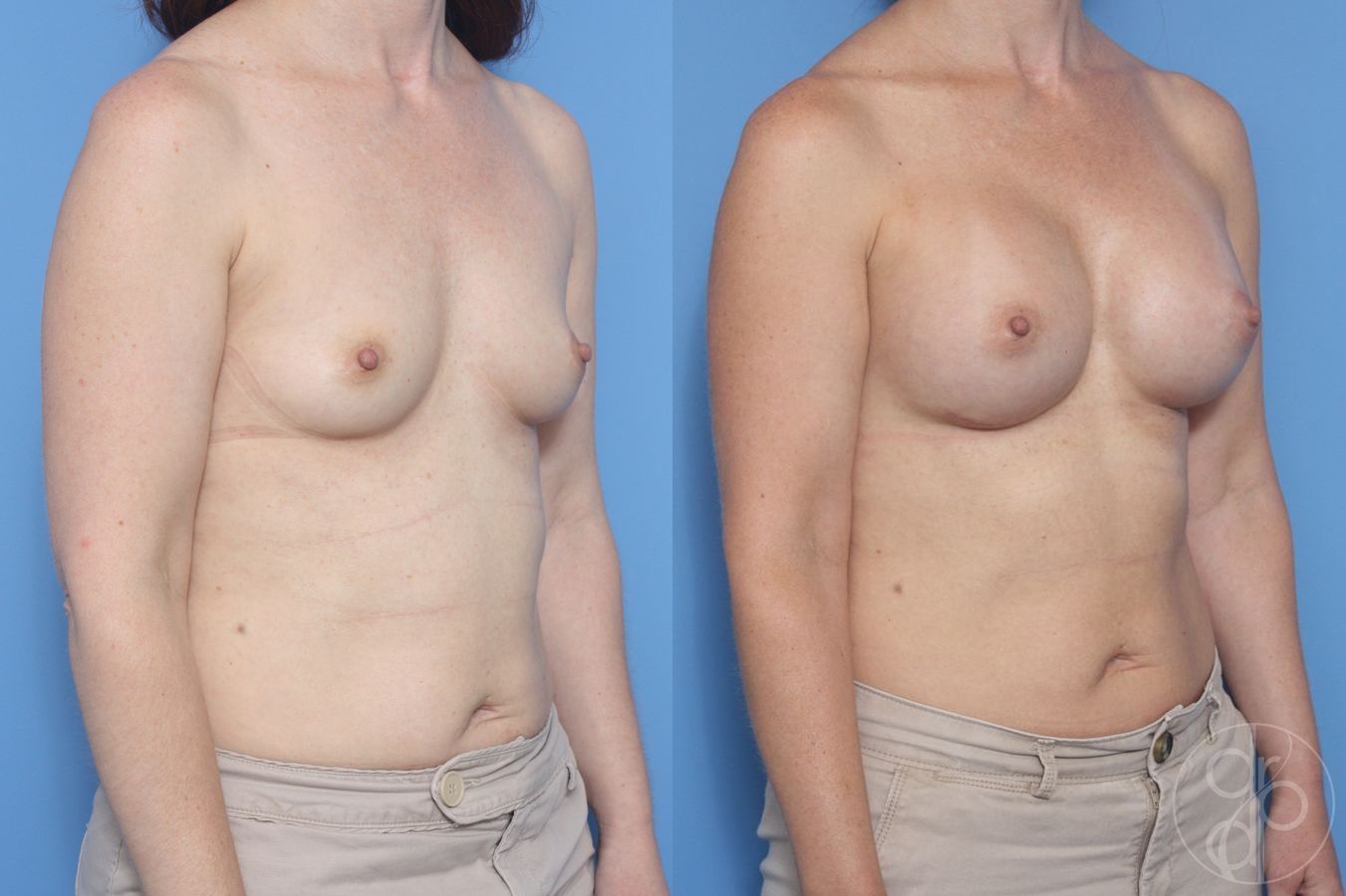 Before and after Breast Augmentation case 29945 - Angle 2