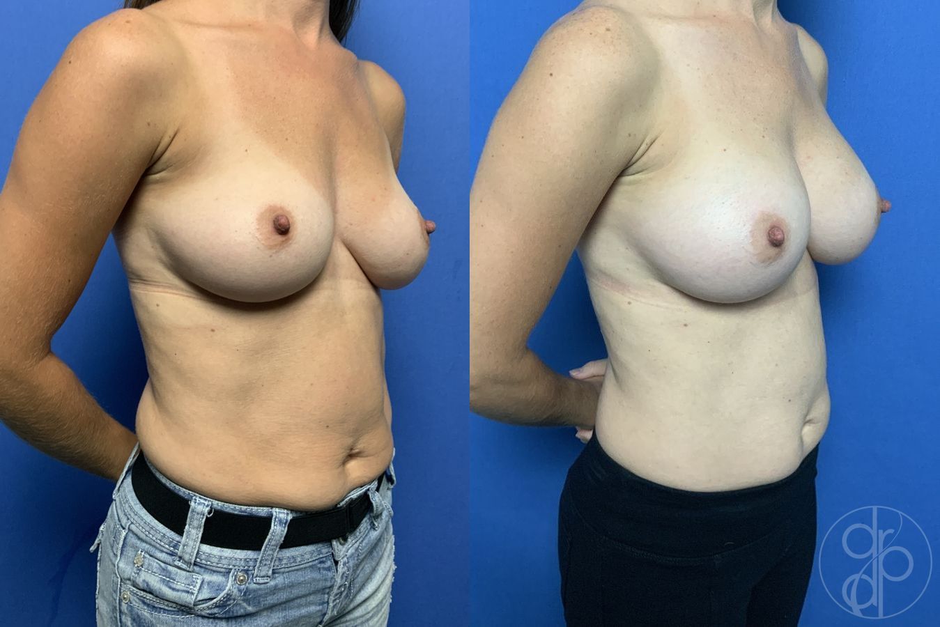 Before and after Breast Augmentation case 29830 - Angle 2