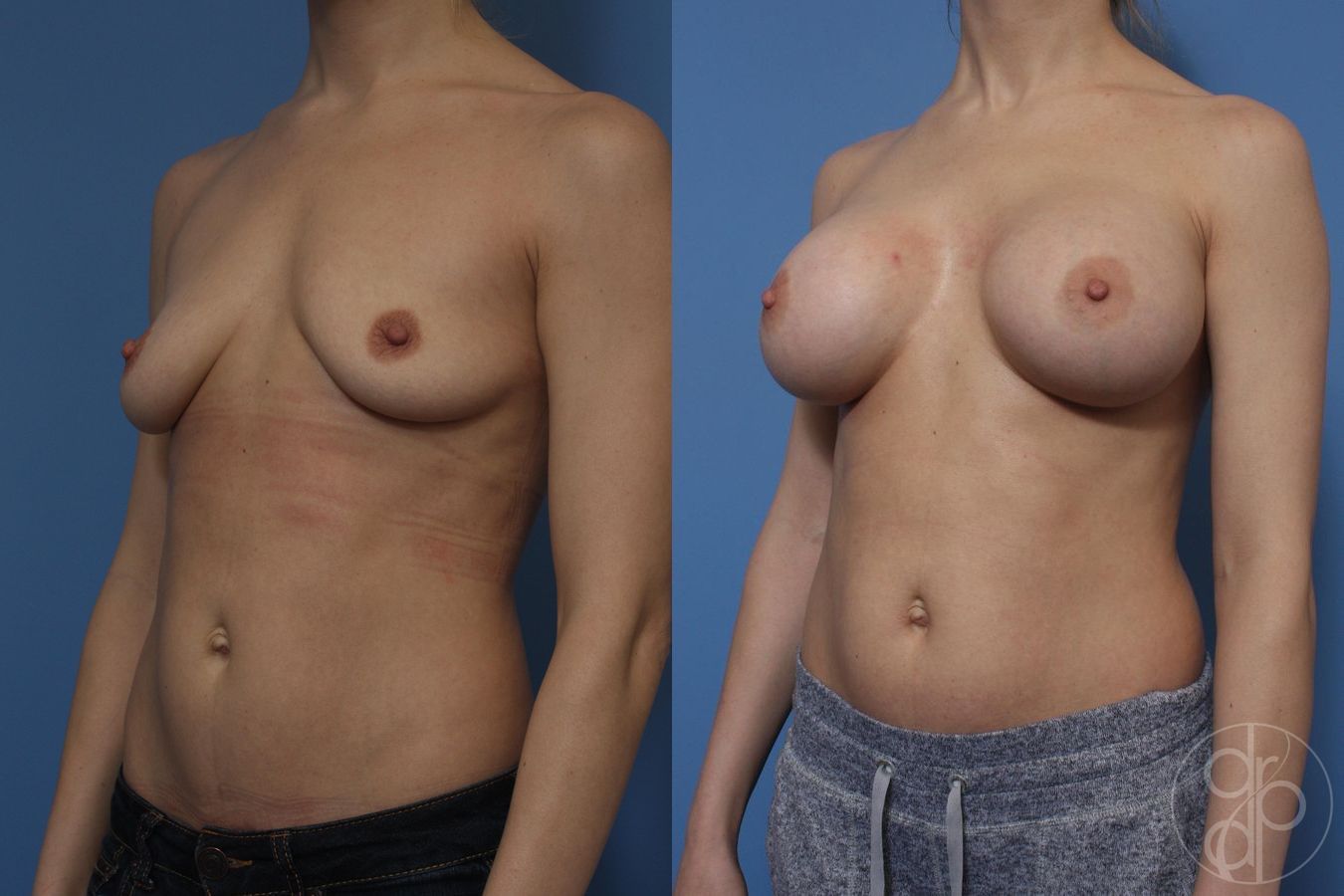 Breast Augmentation - Thumbnail 3