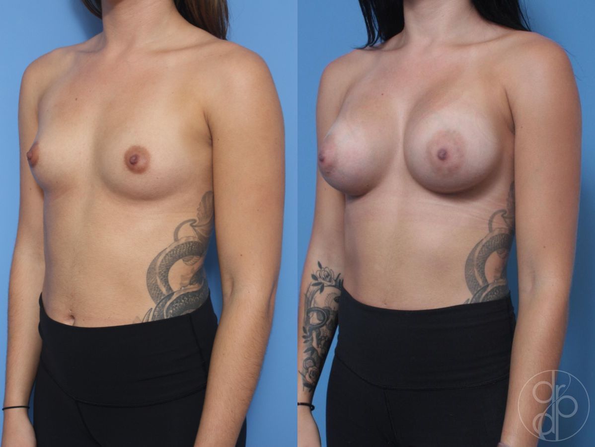 Before and after Breast Augmentation case 29819 - Angle 3