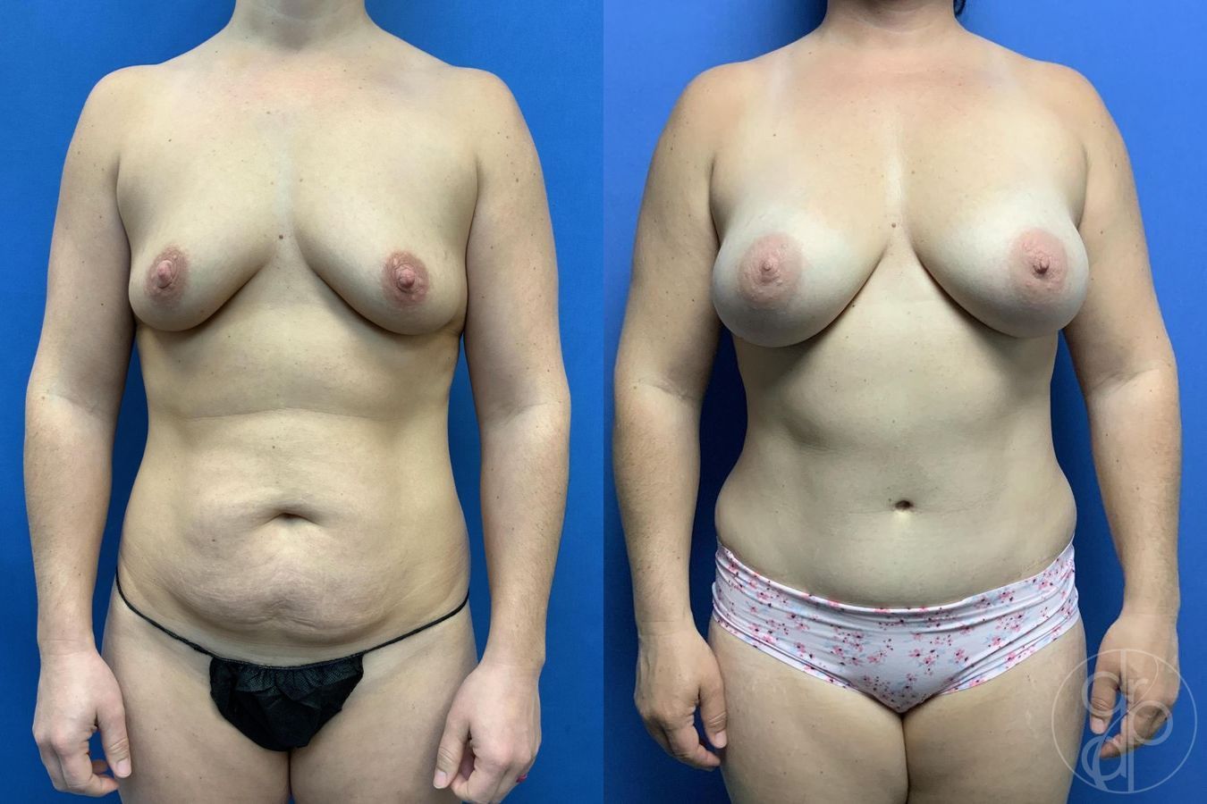 Before and after Breast Augmentation case 29728