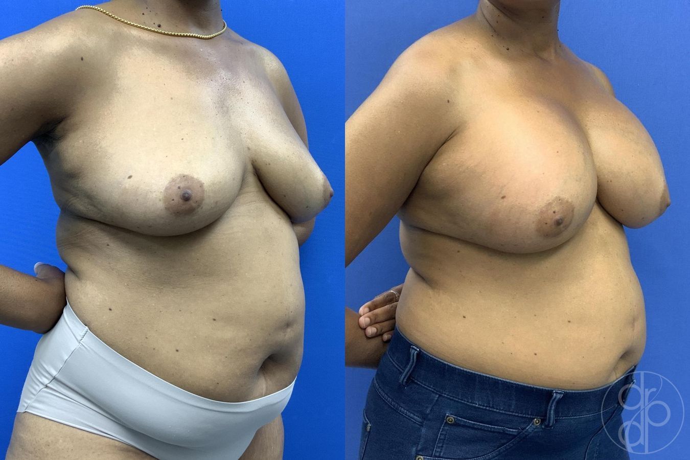 Before and after Breast Augmentation case 30026 - Angle 3