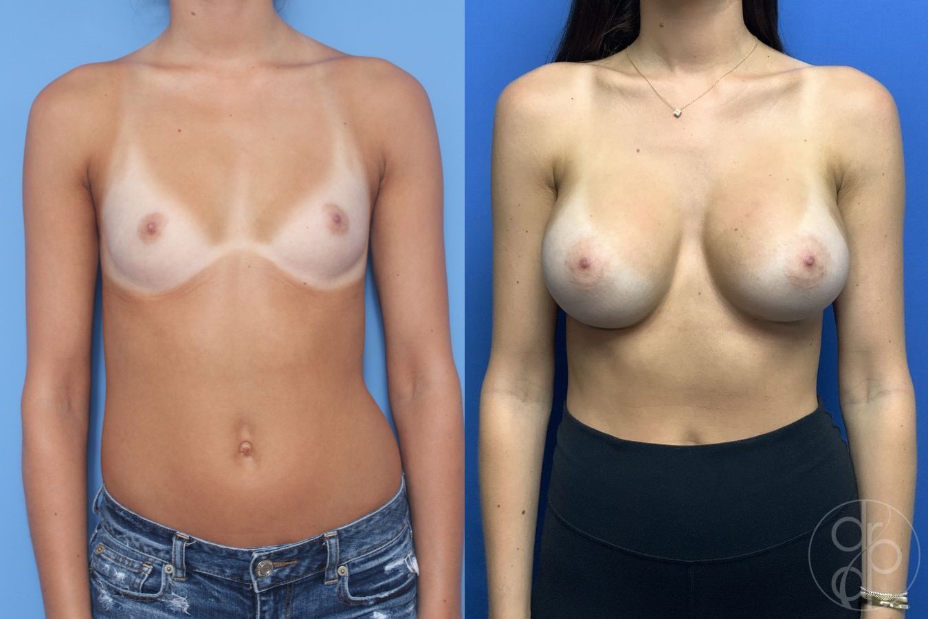 Breast Augmentation - Case 382
