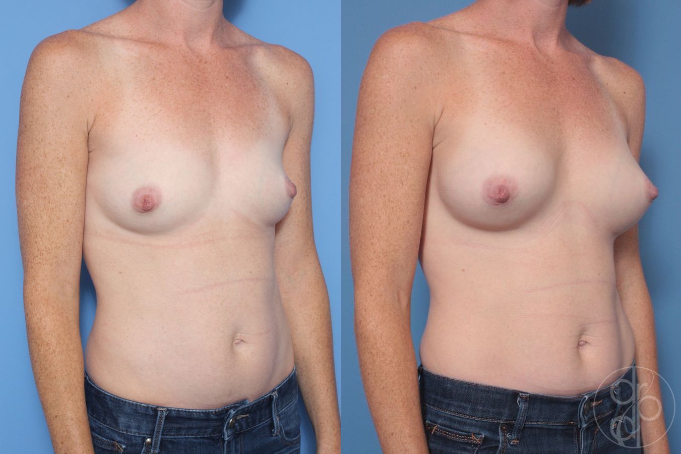 Before and after Breast Augmentation case 29936 - Angle 2