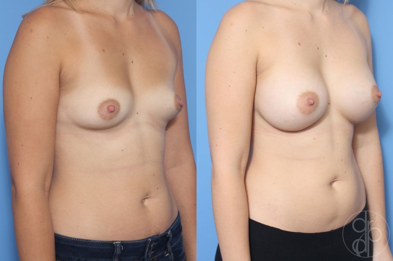 Before and after Breast Augmentation case 29875 - Angle 3
