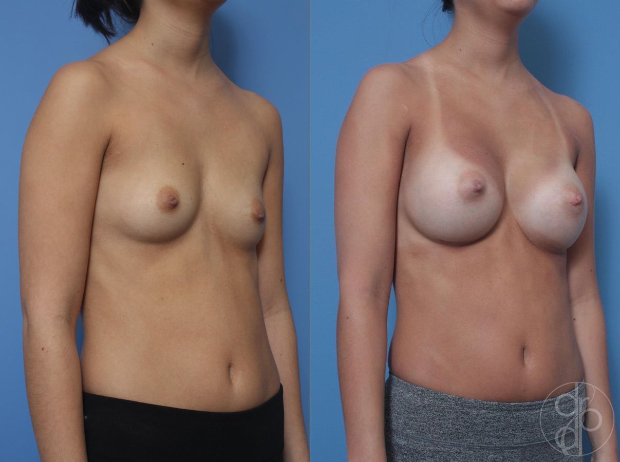 Before and after Breast Augmentation case 29815 - Angle 3